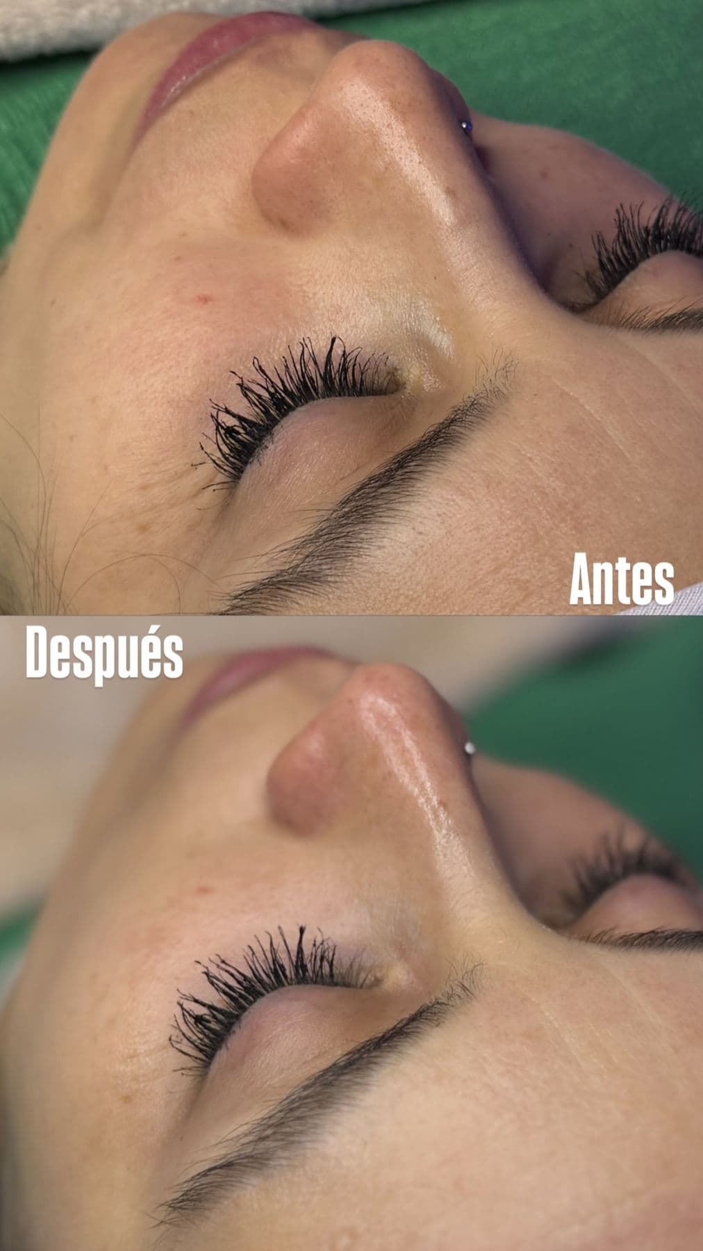 Tratamiento facial, antes y después