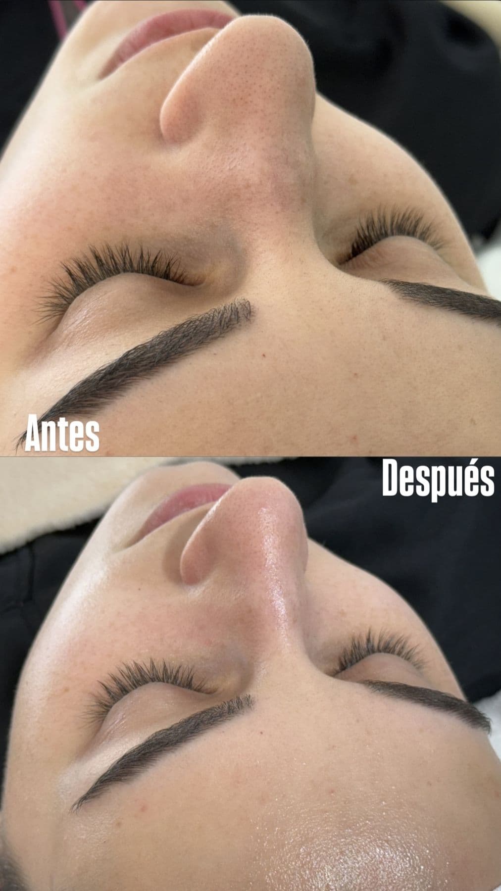 Tratamiento facial, antes y después