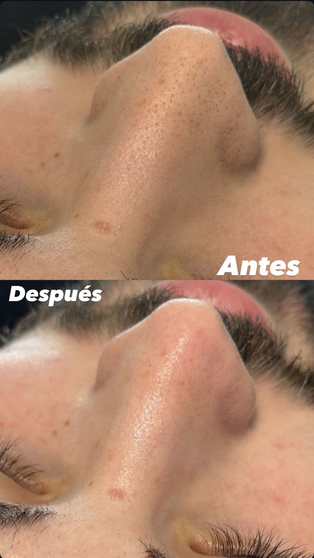 Tratamiento facial, antes y después